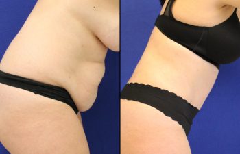 Tummy Tuck/Abdominoplasty Before & After Photos