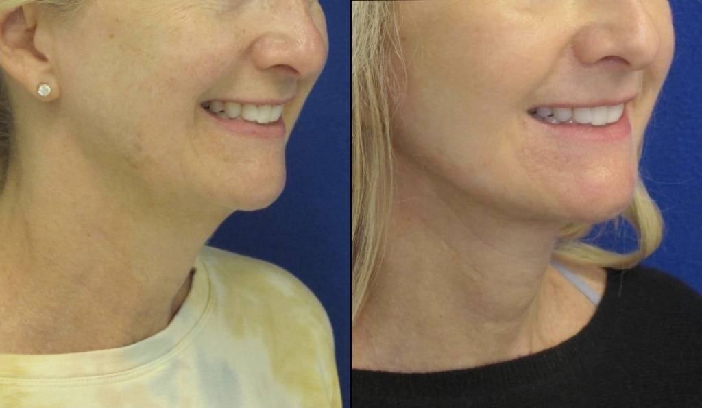 Female Patient Before & After FaceLift