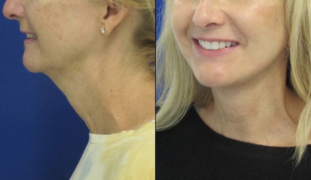 Female Patient Before & After FaceLift