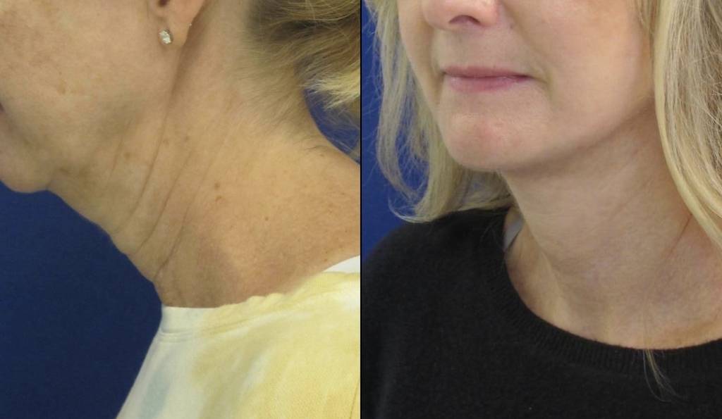 Female Patient Before & After FaceLift