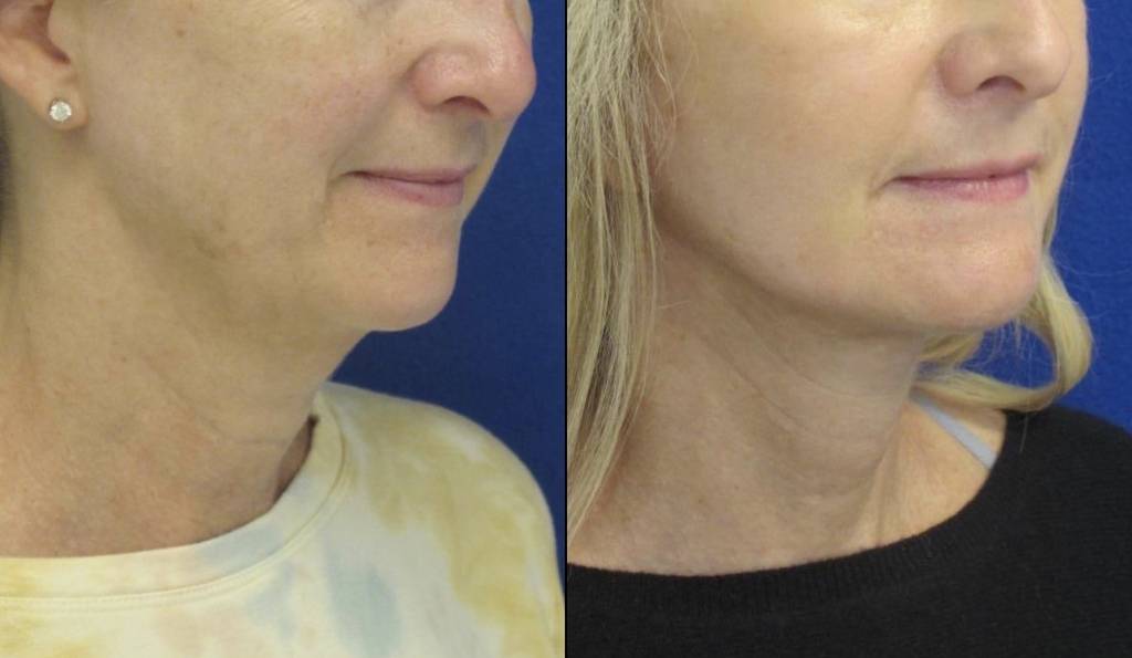 Female Patient Before & After FaceLift