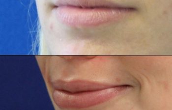 before and after lip filler