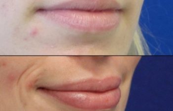 before and after lip filler