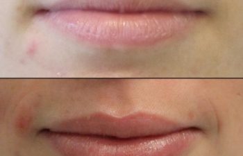 before and after lip filler