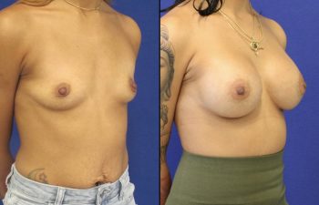 Female Patient Before & After Breast Augmentation