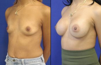 Female Patient Before & After Breast Augmentation