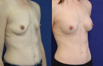 Female Patient Before & After Breast Augmentation