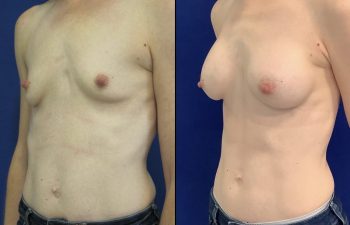 Female Patient Before & After Breast Augmentation