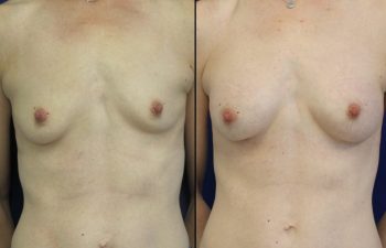 Female Patient Before & After Breast Augmentation