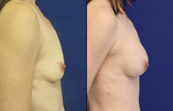 Female Patient Before & After Breast Augmentation