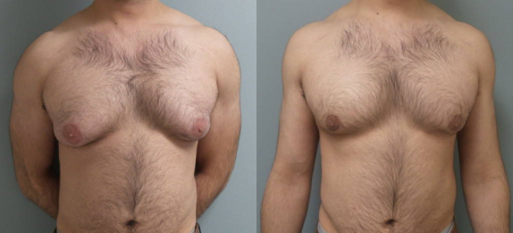 Male Patient Before & After Gynecomastia