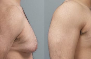 Male Patient Before & After Gynecomastia