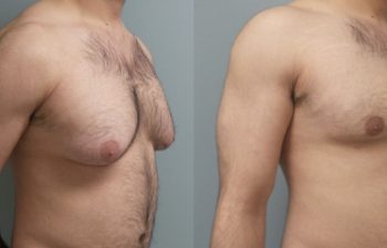 Male Patient Before & After Gynecomastia