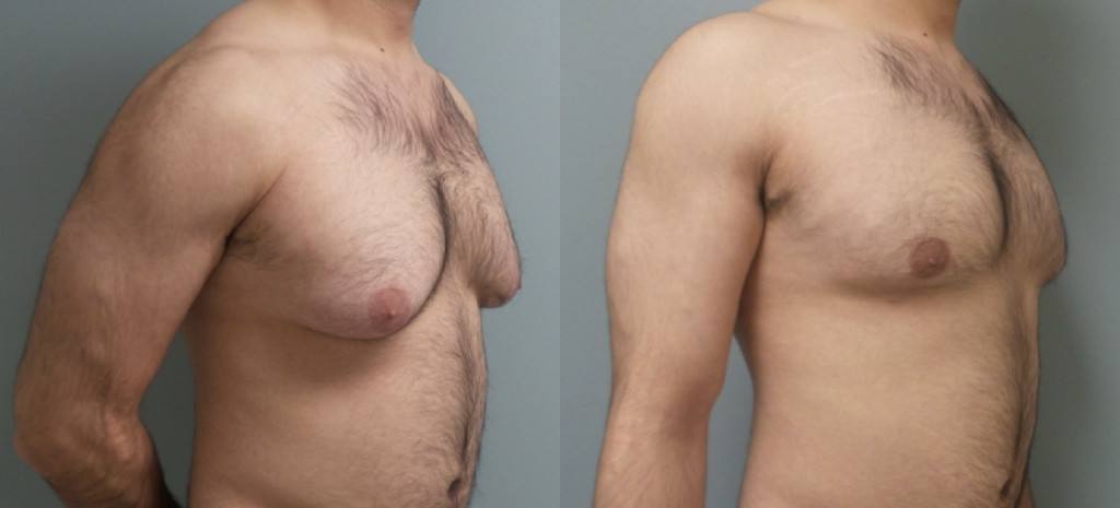 Male Patient Before & After Gynecomastia