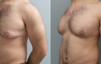 Male Patient Before & After Gynecomastia