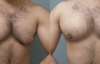 Male Patient Before & After Gynecomastia