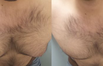 Male Patient Before & After Gynecomastia