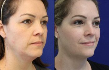 Female Patient Before & After upper blepharoplasty
