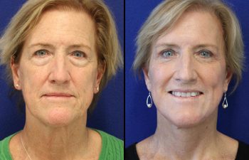 Female Patient Before & After upper blepharoplasty