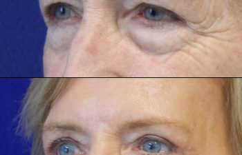 Female Patient Before & After upper blepharoplasty