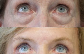 Female Patient Before & After upper blepharoplasty
