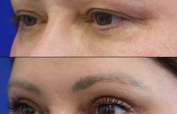 Female Patient Before & After upper blepharoplasty