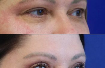 Female Patient Before & After upper blepharoplasty