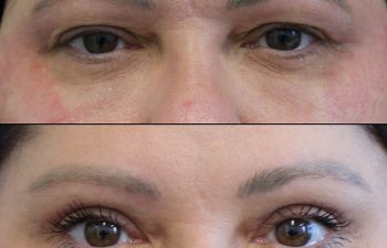 Female Patient Before & After upper blepharoplasty