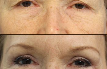 Female Patient Before & After upper blepharoplasty