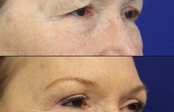 Female Patient Before & After upper blepharoplasty