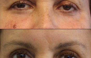 Female Patient Before & After upper blepharoplasty
