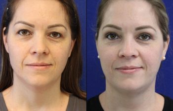 Female Patient Before & After upper blepharoplasty