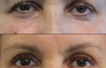 Female Patient Before & After upper blepharoplasty