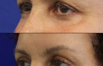 Female Patient Before & After upper blepharoplasty