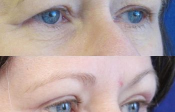 Female Patient Before & After upper blepharoplasty
