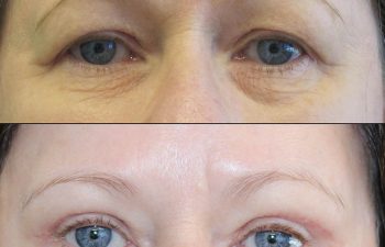 Female Patient Before & After upper blepharoplasty