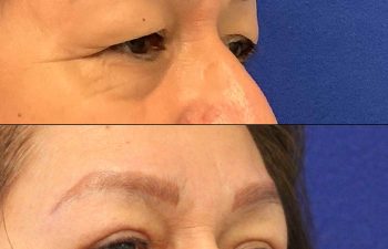 Female Patient Before & After upper blepharoplasty