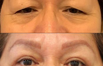 Female Patient Before & After upper blepharoplasty