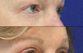 Female Patient Before & After upper blepharoplasty