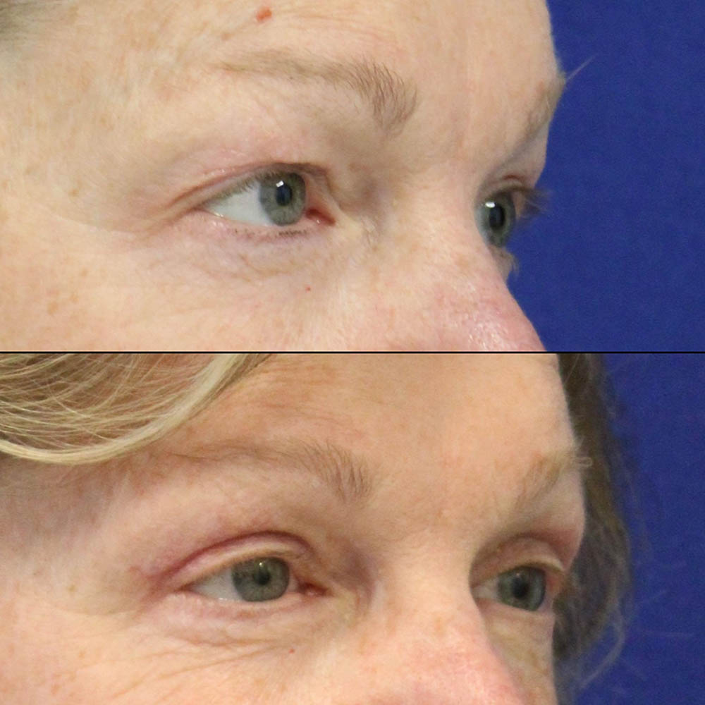 Female Patient Before & After upper blepharoplasty