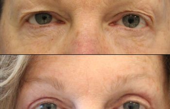 Female Patient Before & After upper blepharoplasty