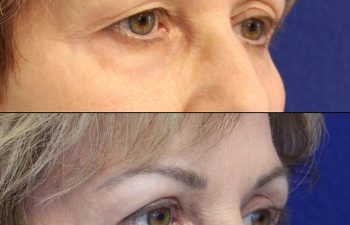 Female Patient Before & After upper blepharoplasty