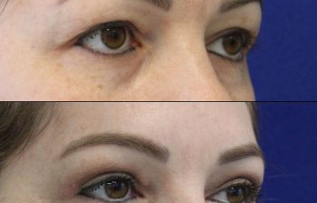 Female Patient Before & After upper blepharoplasty