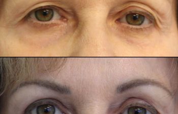 Female Patient Before & After upper blepharoplasty