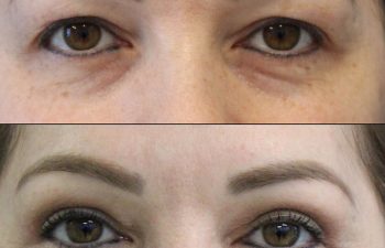 Female Patient Before & After upper blepharoplasty