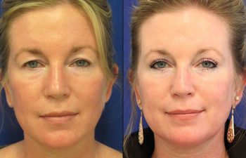Female Patient Before & After upper blepharoplasty