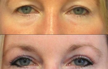 Female Patient Before & After upper blepharoplasty