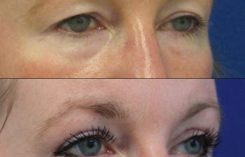 Female Patient Before & After upper blepharoplasty