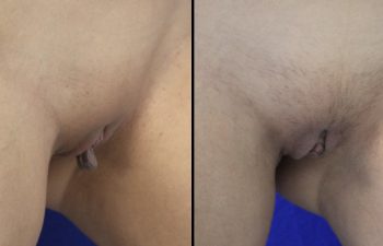 Female Patient Before & After Labiaplasty