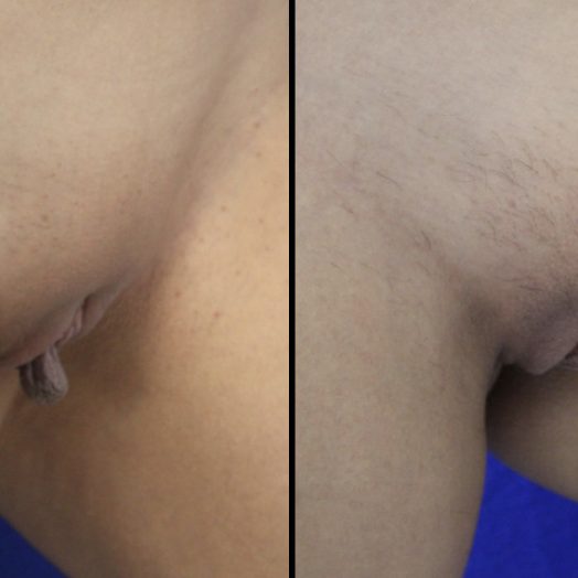 Female Patient Before & After Labiaplasty